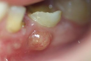 آبسه دندان،Periodontal Abscess